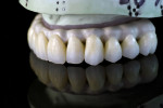 Fig 18. The milled zirconia full-contour crowns assembled on the framework and refined prior to glazing.