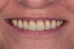 Fig 24. Postoperative close-up smile view of the final prosthesis.