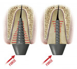 Figure 4  A schematic drawing of the stress produced by a tapered solid shank post: resulting in high retention and extremely high stress upon insertion and under function versus a drawing of the stress produced by a threaded parallel solid shank: re