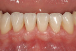 Figure 5  Final restorations mandibular anterior teeth Nos. 22 to 27.