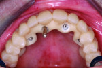 Fig 5. The laboratory-fabricated trial denture was placed to verify the bite, lip line, smile line, overjet, overbite, and smile design.