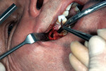 Figure 2  An apicoectomy was performed to remove granulation tissue and the instrument.