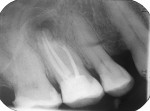 Figure 6  Postoperative radiographs show a complete removal of the root canal instrument and bone defect around the mesio-buccal root.