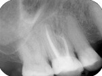 Figure 8  Dental film recorded 7 months after retrograde root-end filling with Biodentine shows complete bone regeneration. Any pathological findings apical of tooth No. 16 were not visible.