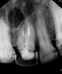 Fig 8 through Fig 10. Periapical radiography at 1-year follow-up showing normality in periapical tissues, in addition to prosthetic tooth rehabilitation.