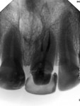 Fig 8 through Fig 10. Periapical radiography at 1-year follow-up showing normality in periapical tissues, in addition to prosthetic tooth rehabilitation.