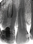 Fig 5 through Fig 7. Final periapical radiography immediately after endodontic treatment.