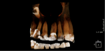 Fig 1 and Fig 2. Preoperative radiography showed unusual tooth No. 9 anatomy.