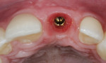 Fig 16. Implant placed in the planned site (implant placement by Maurice A. Salama, DMD).