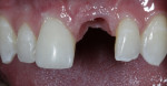 Fig 17. Soft tissue was molded with a provisional restoration. Note that the gingival contour emergence profile from the implant preserved and maximized the soft tissue in the mouth.