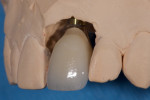 Fig 18. The contour of the final restoration followed the soft-tissue contours that were created with the provisional.