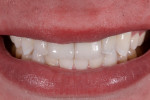 Fig 21. The patient’s smile with the final restorations.