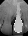 Fig 22. Final radiograph showing proper crown-to-implant transition.