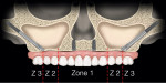 Fig 1. Zygomatic concept, which is indicated in the absence of alveolar bone in zones 2 (Z2) and 3 (Z3).