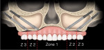 Fig 2. Quad-zygoma concept, which is indicated in the absence of alveolar bone in zones 1, 2 (Z2), and 3 (Z3).