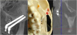 Fig 4. In the zygoma bone, narrower-diameter zygomatic implants are preferred.
