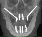 Fig 10. Postoperative radiograph of patient treated with the zygomatic concept.
