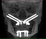 Fig 11. Postoperative radiograph of patient treated with the quad-zygoma concept.