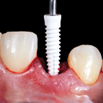 Once the shaping was complete, a 3.5 x 12 mm zirconia implant (Zeramex® XT, Zeramex) was immediately placed into the osteotomy site and torqued to initial stability.