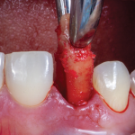 Removal of fractured root was facilitated with an ultrasonic bone cutting system (Piezomed, W&H) and standard forceps.