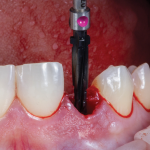 The final shaping of the osteotomy was performed with a carbon-coated shaping drill.