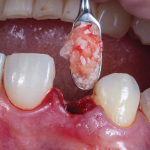 Insertion of the grafting material into the 2 mm of buccal space.