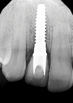 Radiographic confirmation of the positive seat of the two-piece zirconia implant/abutment system with the carbon fiber screw.
