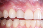 A 2-week postoperative image of the temporary restoration in place, demonstrating healthy and well-supported papillae around the ceramic implant.