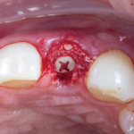 Occlusal view of the ceramic implant with a flat polyether ether ketone (PEEK) healing cap inserted into its internal aspect and the grafting material in place.