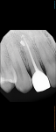 Preoperative radiograph demonstrating previous endodontic treatment that was failing.