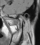 MRI scans of the right-side TMJ joints with the mouth closed and open, respectively, demonstrating the disc in place.