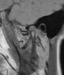 MRI scans of the left-side TMJ joints with the mouth closed and open, respectively, demonstrating the disc anteriorly displaced without reduction.