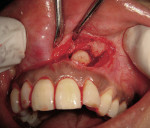 Figure 2  Semi-lunar full-thickness flap reflected, showing the coronal aspect of the impacted canine.