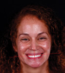 Fig 1. The patient presents with dentures that look unnatural, plus a canted smile, cervical lines showing no symmetry, and incisal edges covered by her lower lip.