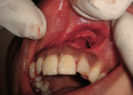 Figure 3  Resulting defect following extraction of the impacted canine.
