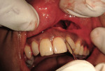 Figure 4  Atraumatic extraction of the lateral incisor.