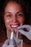 Fig 9. Obtaining the size of the two central incisors by keeping the caliper in the same position as in Figure 8.