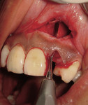 Figure 5  Communication between the lateral incisor extraction site and impacted canine site but the buccal crestal ridge has been preserved.