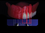 Fig 13. Arranging the six maxillary anterior teeth by following the patient’s facial proportions to achieve symmetry and to continue with the full setup of the remaining arches.