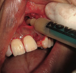 Figure 6  NovaBone being utilized for the bone graft over the facial defect.