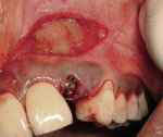 Figure 10  Additional NovaBone was placed over the exposed implant and filling the defect.