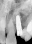 Figure 12  Radiograph at implant placement with graft filling the defect.