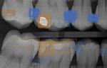 Fig 3. Example of variation in diagnosis among dentists. In an experiment for caries identification with 75 US licensed dentists, the raw image on the left was presented without annotation. The correct caries identification is now noted in blue boxes on the left image. The image on the right represents the aggregate output from the dentists and demonstrates significant variation in caries diagnosis. Every tooth was diagnosed as requiring treatment. Source: Overjet Inc.