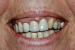 Fig 2. The patient’s smile pretreatment revealed a congenitally missing left lateral incisor and canine substitution exacerbating the canted gingival margins.