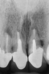 Fig 3. Pretreatment radiograph. Note apical lesions, advanced bone loss, and compromised tooth structure.