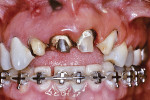 Fig 4. The prosthodontist removed the crowns from teeth Nos. 7 through 9 in preparation for provisional crowns prior to orthodontic eruption.