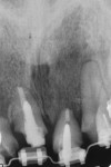 Fig 7. Radiograph after orthodontic eruption. Note significant coronal movement of the crestal bone at Nos. 9 and 11.