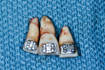 Fig 8. Extracted teeth Nos. 7, 8, and 9 at the time of implant surgery.