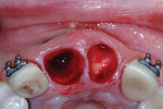 Fig 9. Extraction sockets Nos. 8 and 9. Note significant crestal bone regeneration in the intact sockets.