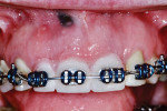 Fig 11. The orthodontist placed a fixed wire temporary as a replacement for Nos. 7 through 9 and ligated it in place immediately after surgery.